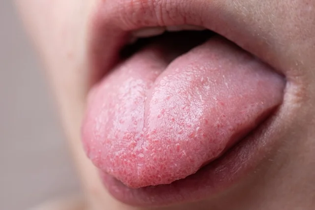 The Tongue Pop